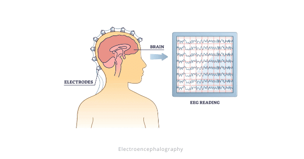 Electroencephalography