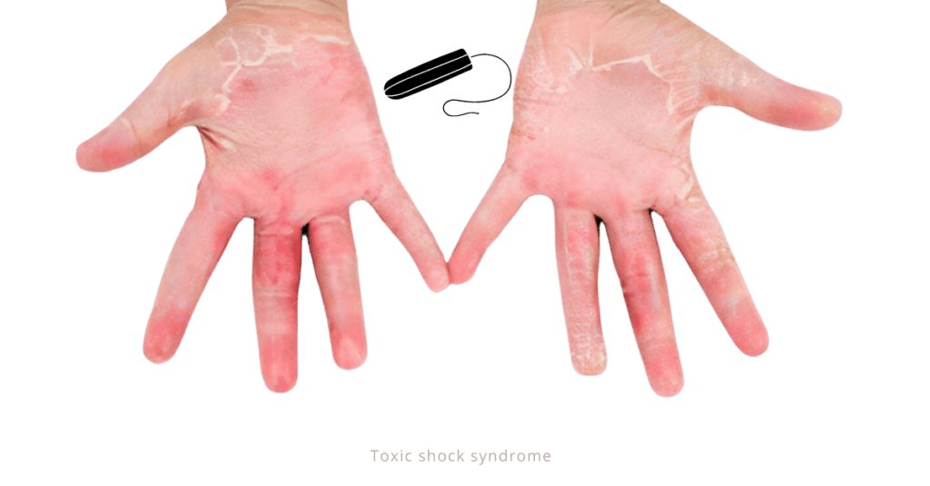 Toxic shock syndrome